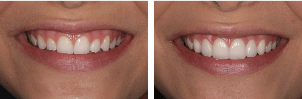 Before and After Gum Recontouring showing how more teeth show after the procedure. 